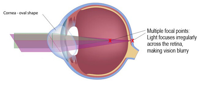 Chart Showing an Eye With Astigmatism