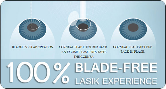 100% Blade-Free LASIK Experience