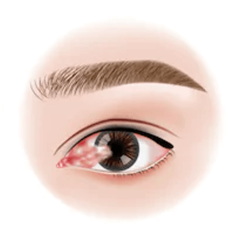 Illustration of Pterygium in an Eye