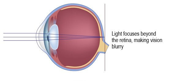 Chart Showing an Eye With Hyperopia