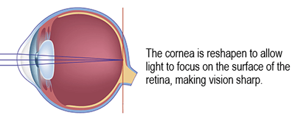 Chart Showing an Eye After LASIK Surgery