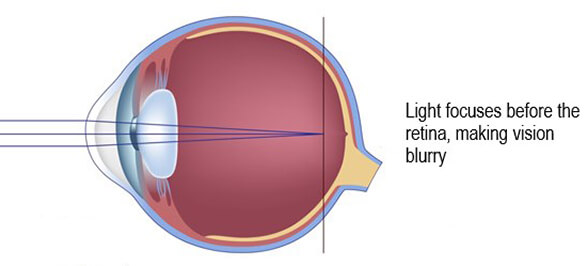 Chart Showing an Eye With Myopia