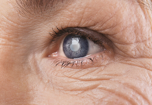 Cataract in an Eye