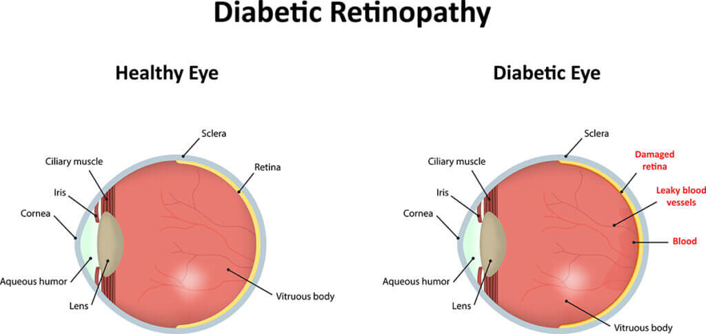 Chart Showing a Healthy Eye Compared  to One With Diabetic Retinopathy