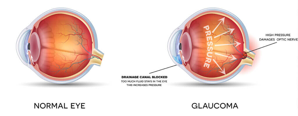 Chart Showing a Normal Eye Compared to One With Glaucoma