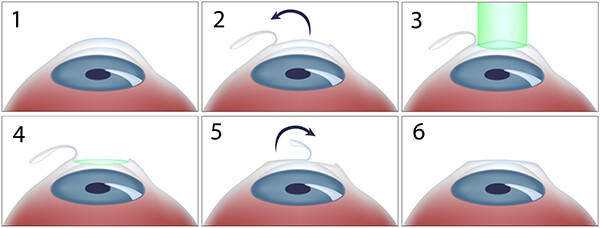 Chart Showing the LASIK Process